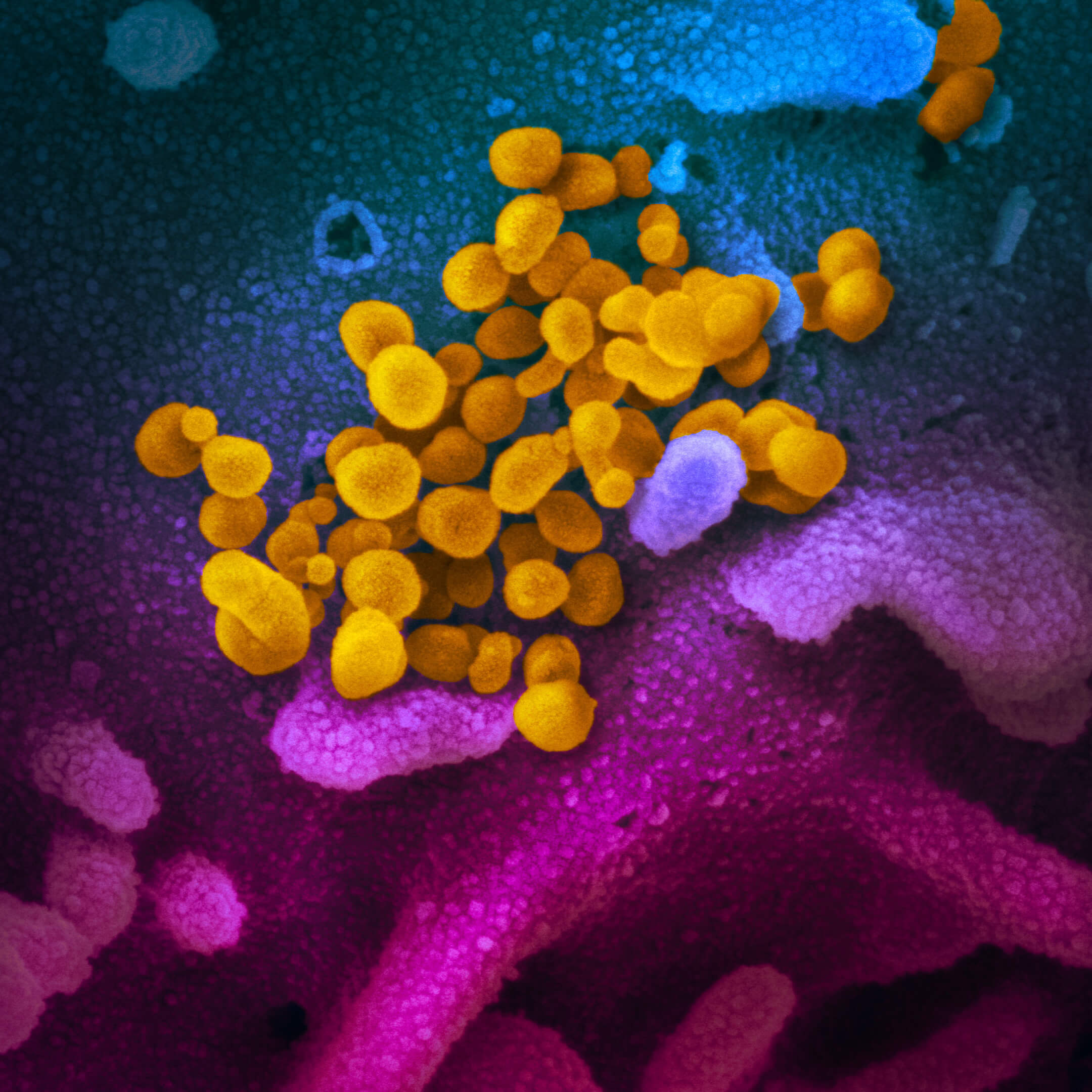 Изображение вируса SARS-CoV-2, полученное с помощью электронного микроскопа. Вирус раскрашен желтым цветом / ru.wikipedia.org